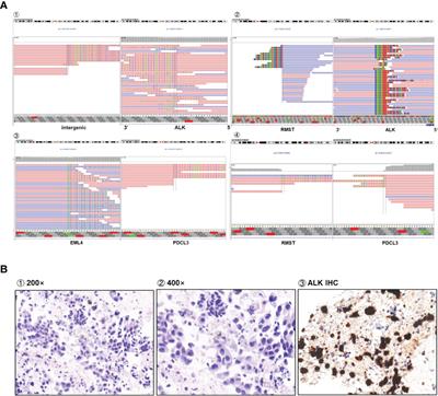 Identification of a novel RMST-ALK rearrangement in advanced lung adenocarcinoma and durable response to ceritinib: A case report